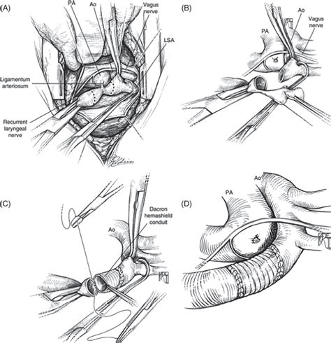 Coarctation Of The Aorta Thoracic Key