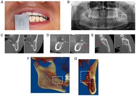 Persistent Trismus Following Mandibular Third Molar Extraction And Its