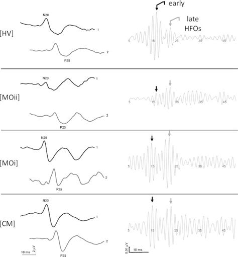 Schematic Representation Of The Changes In Somatosensory Evoked