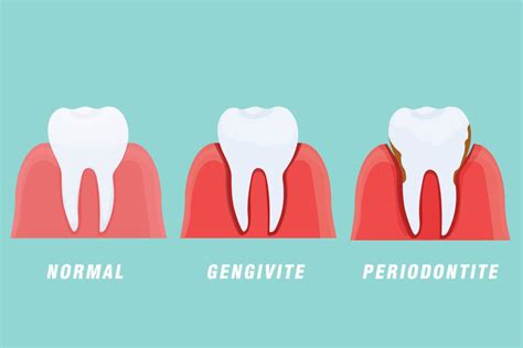 Benestar Odontontologia Periodontite E Gengivite Como Prevenir