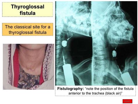 Thyroid Presentation