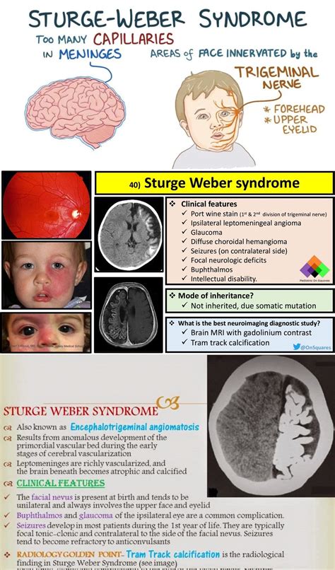 Sturge Weber Mri