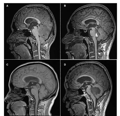 Figure 1 From Management Of Posterior Fossa Tumors In Adults Based On The Predictors Of