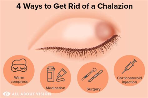 What Is The Bump On My Eyelid Treatment Of A Chalazion Nbkomputer