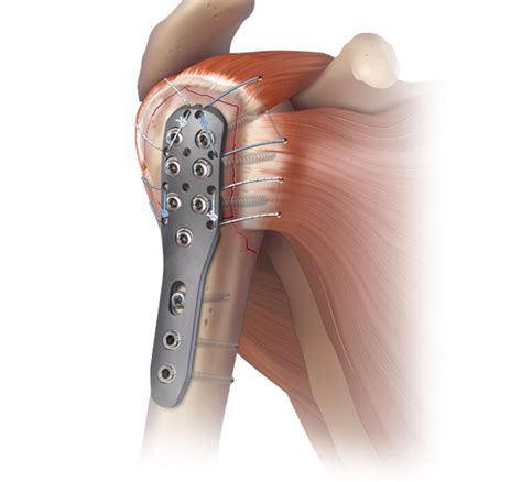 Arthrex Humeral Fracture Implants