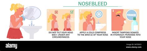 understanding   treat  nosebleed  crucial  effective relief