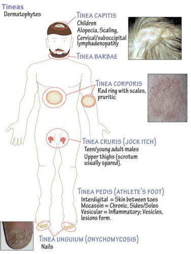 Cutaneous And Subcutaneous Mycoses Flashcards Quizlet