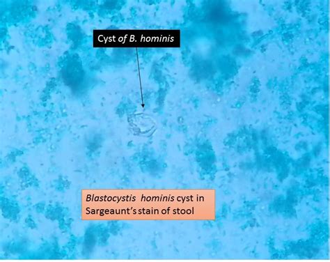 Blastocystis Hominis In Stool