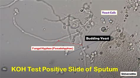 Fungal Keratitis