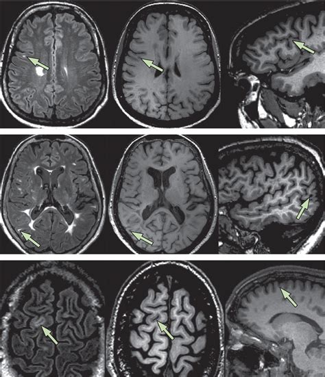 Mri Criteria For The Diagnosis Of Multiple Sclerosis Magnims Consensus Guidelines The Lancet