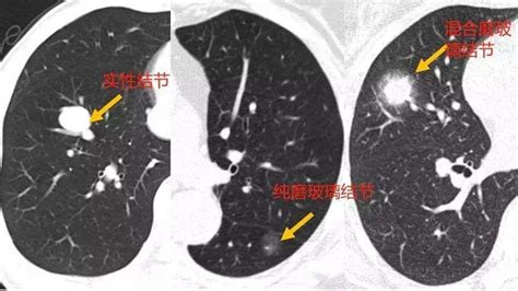 肺结节是什么？疾病百科朗合医疗