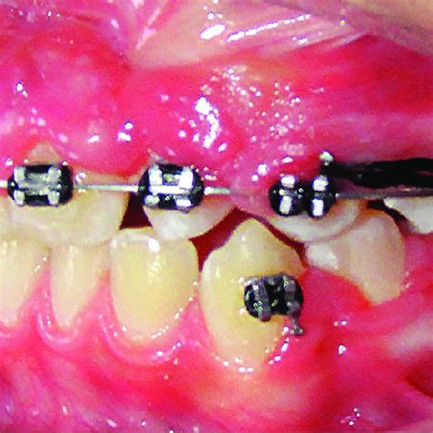 Feeding plate/ palatal obturator | Download Scientific Diagram