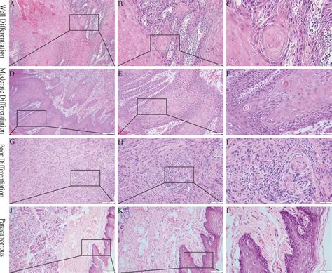 Frontiers Tissue Mechanics Modulate Pcnp Expression In Oral Squamous