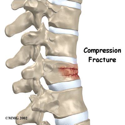 Spinal Compression Fracture | Singapore Sports & Orthopaedic Surgeon