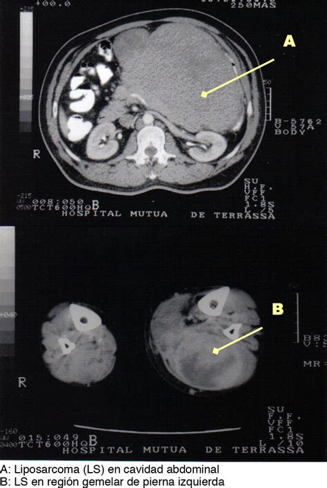 Liposarcoma Multicéntrico Sincrónico Y Metacrónico Cirugía Española