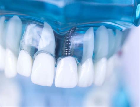 Tooth Extraction And Implant Timeline Dentaltreatment