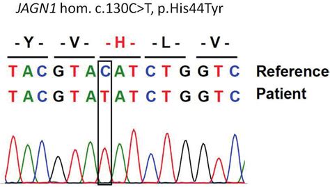 Mutation Analysis Of The Patient By Sanger Sequencing Download