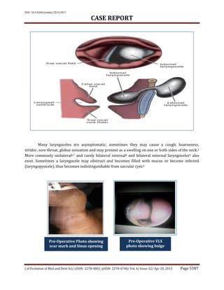 Laryngocele | PDF