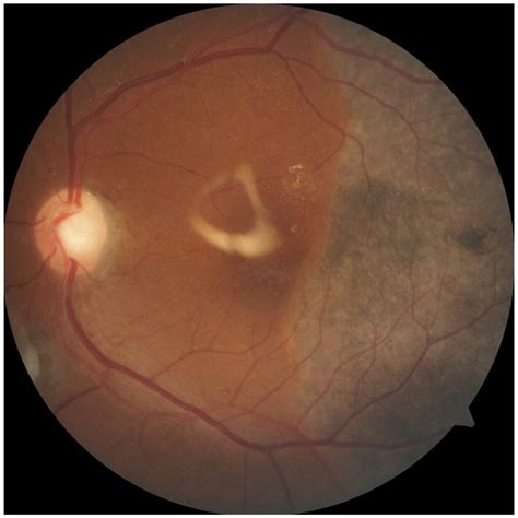 Giant Retinal Pigment Epithelium Tear Resulting In Neurosensory Retinal