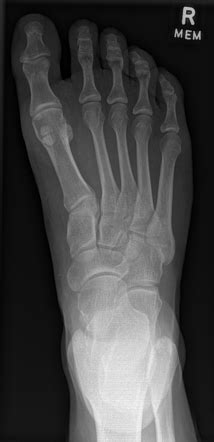 Hallux Sesamoid Fracture Radiology Case Radiopaedia Org