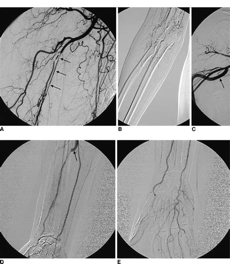 Upper Extremity Angiogram Procedure Ideas Para Sesion De Fotos De