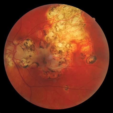 Toxoplasmosis Retinal Scar