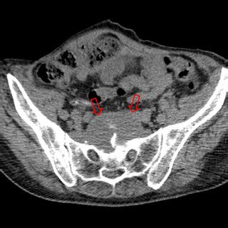 Transverse CT Image Showing Deep Pelvic Abscess Located At Presacral