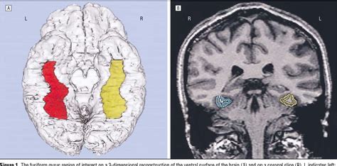 Parahippocampal Gyrus Mri