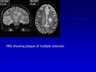 PPT - MRI showing plaque of multiple sclerosis. PowerPoint Presentation ...