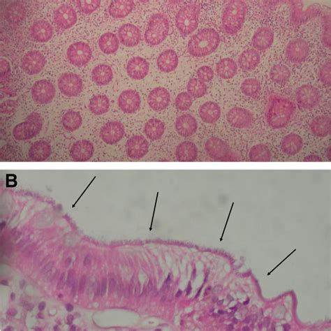 A Hematoxylin And Eosin Stain Of Colon Biopsy Specimen Showing Download Scientific Diagram