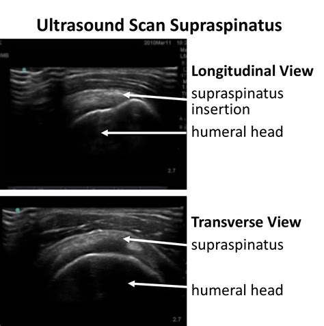 Imaging Cambridge Shoulder