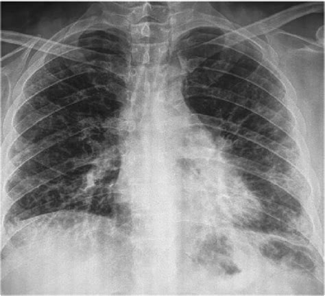 X Ray Chest Diffuse Interstitial Lung Disease Download Scientific Diagram