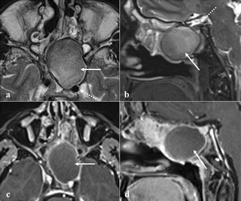 Left Sphenoid Sinus Mucocele With High Protein Content In A 53 Year Old