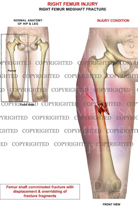 Right femur injury – Medical Art Works