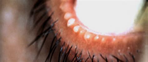 Blepharitis Lidrandentz Ndung Posiforlid