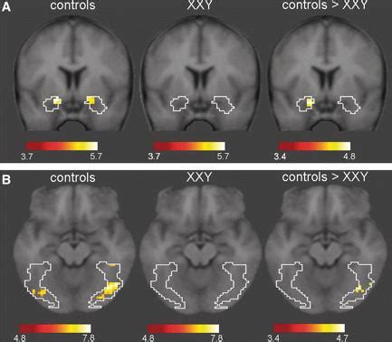 File:FMRI Images of Brain Activation in XXY Patients.JPG - Embryology