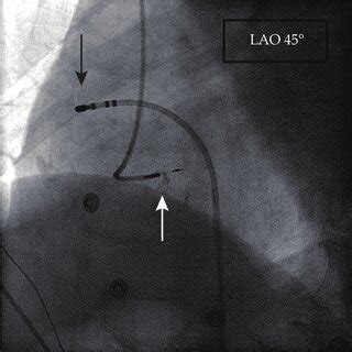 atrioventricular node ablation cardiac electrogram recording