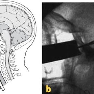 (a) Illustration of transsphenoidal endoscopy procedure and (b) plain ...