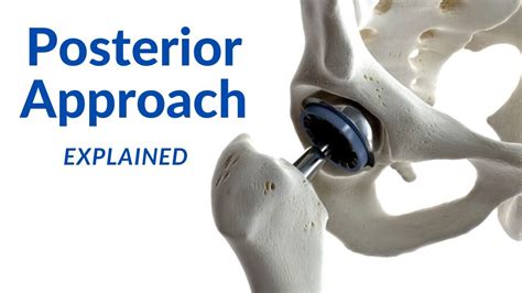 Posterior Approach To The Hip Southern Moore Youtube