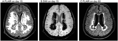 Sepsis Associated Encephalopathy With Multiple Microbleeds In Cerebral