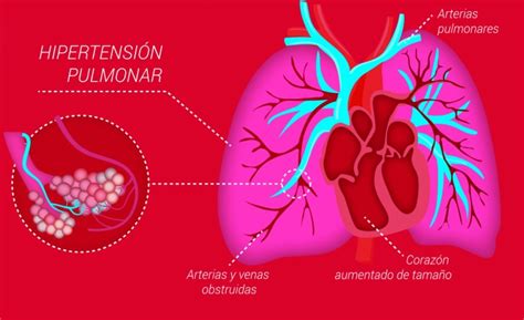 Hipertensión Pulmonar Severa Archivos El Blog De La Fundación Contra