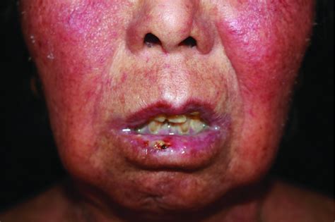 Mercury Induced Cutaneous Poisoning With Generalised Erythema And Pruritic Blister Indian