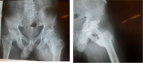 Figure From Myositis Ossificans Of The Hip Joint Causing Sciatic