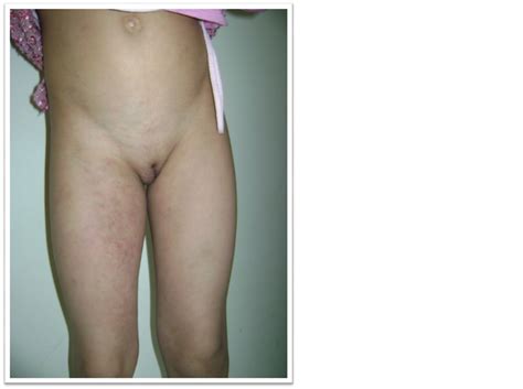 Klippel Trenaunay Syndrome A Rare Cause Of Vaginal Bleeding In The