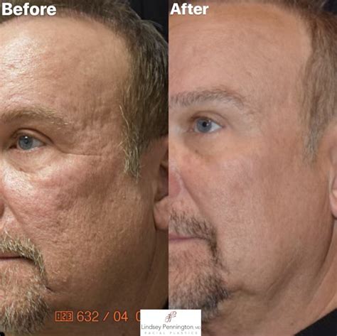 Microneedling With Rf And Prp Before And After Gallery Pennington