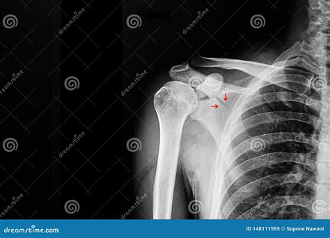 Fracture Scapular Stock Image Image Of Medicine Lung 148111595