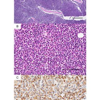 Microscopic Findings Of Bone Marrow A Low Power View Of Bone Marrow