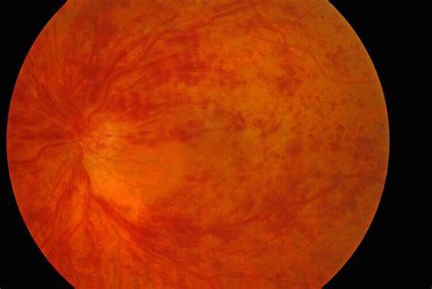 Central Retinal Vein Occlusions - Retina Consultants Of Michigan