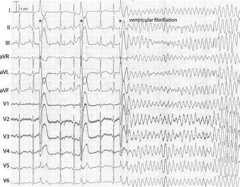 Ventricular Fibrillation - Heart and Blood Vessel Disorders - Medicine.com