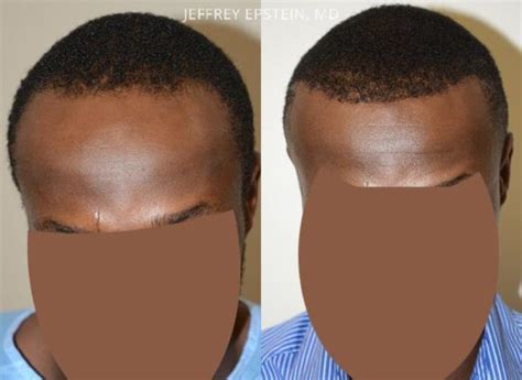 Forehead Reduction Surgery Photos Miami FL Patient37089